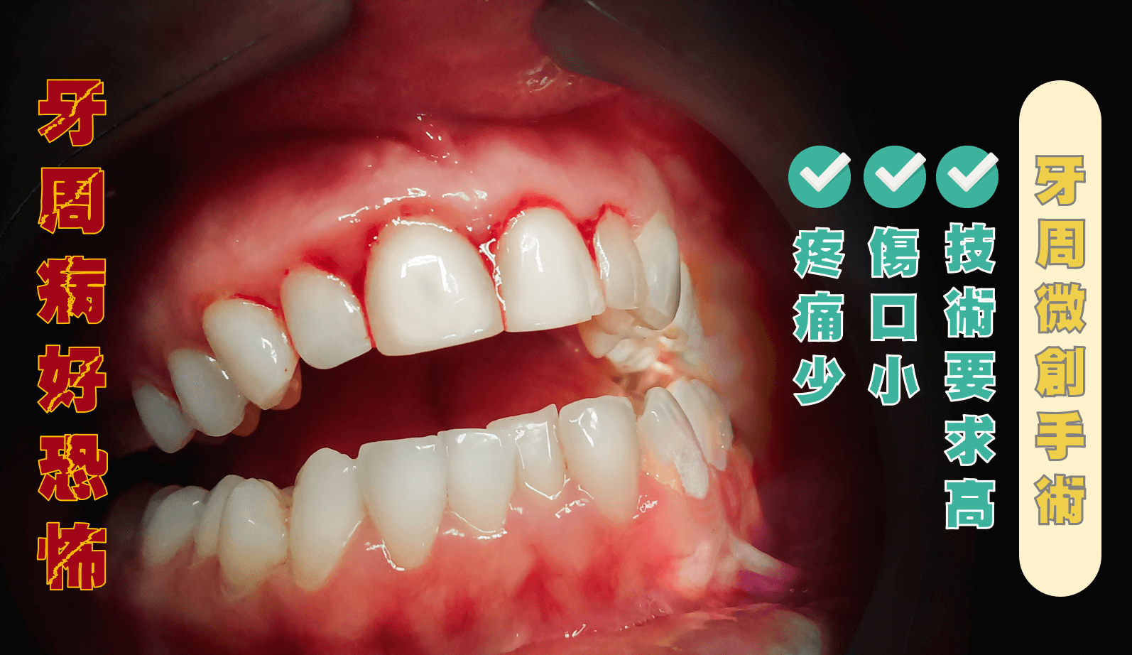 牙周病造成牙齦流血
