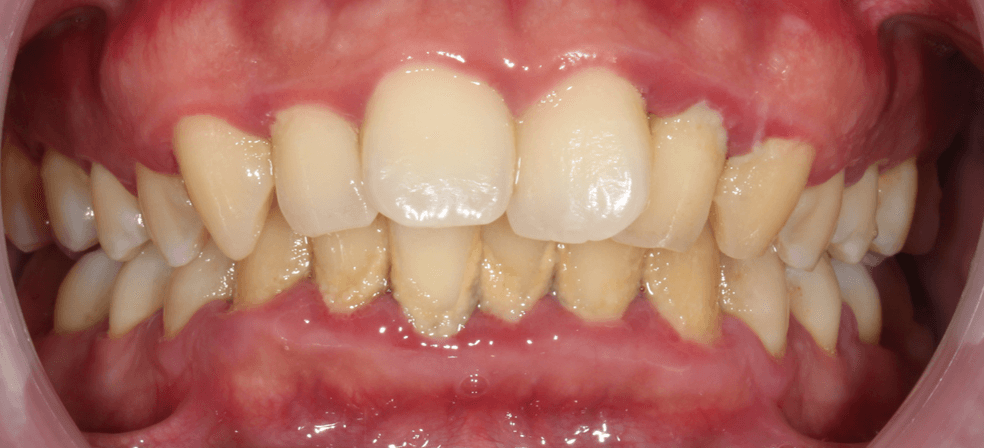 牙齒清潔不易導致常有蛀牙和牙齦發炎流血