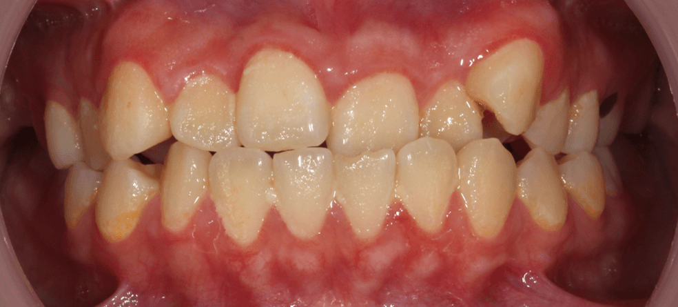 牙齒錯咬造成牙齒不當的磨耗