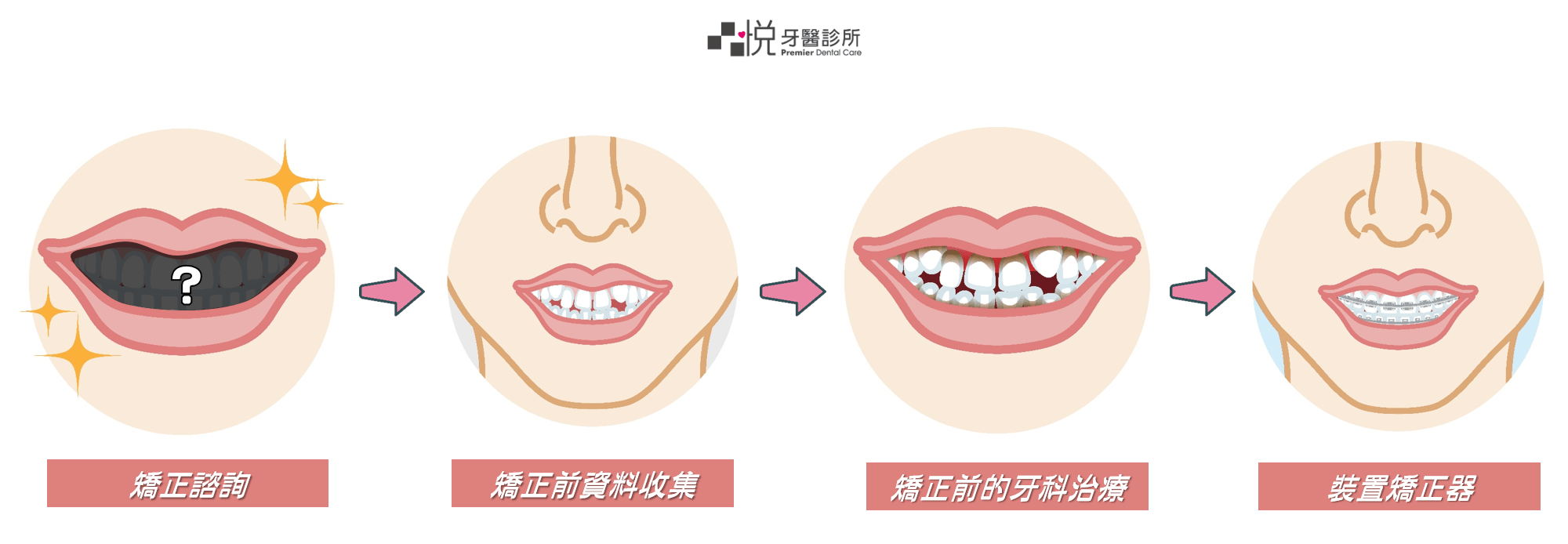 牙齒矯正流程