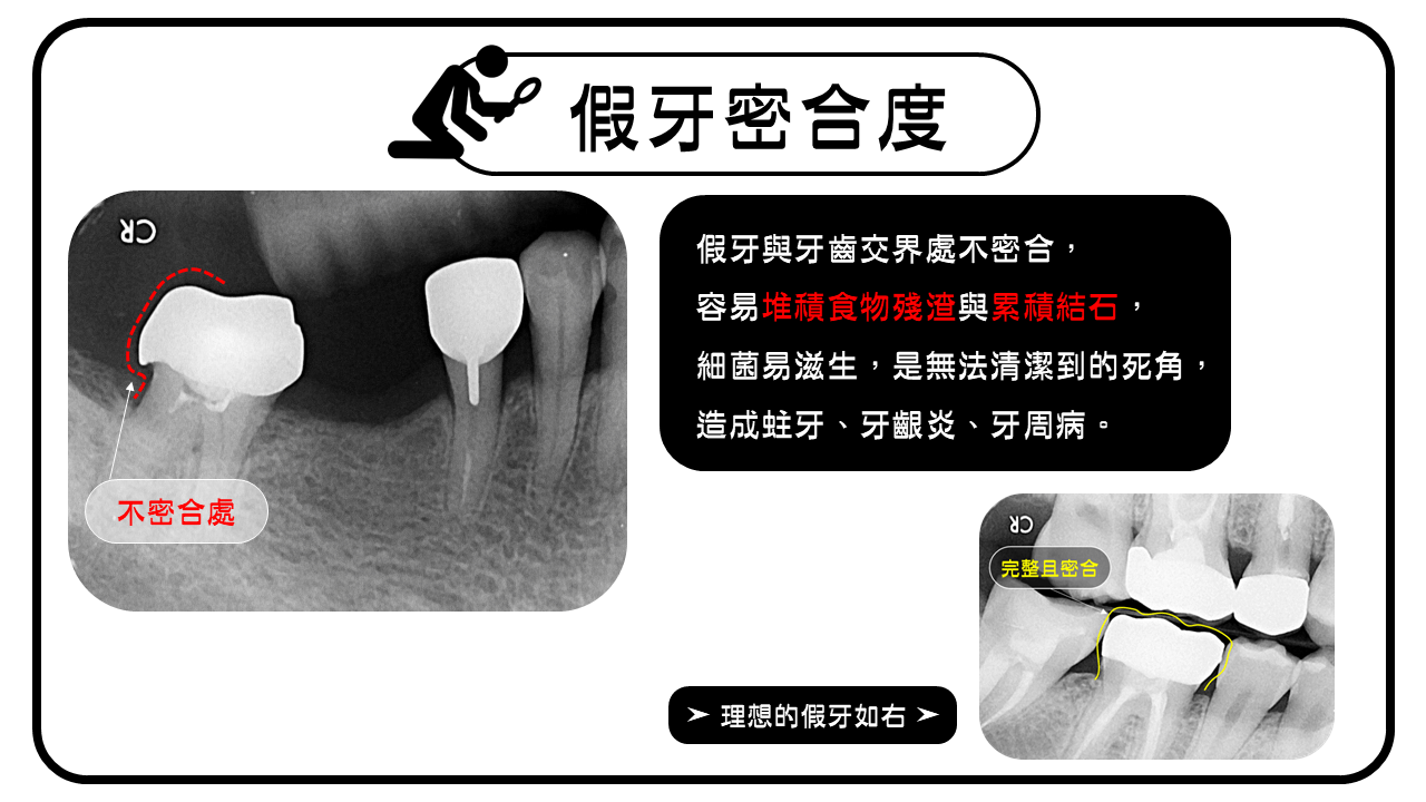 X光片可以看到舊有的假牙不密合