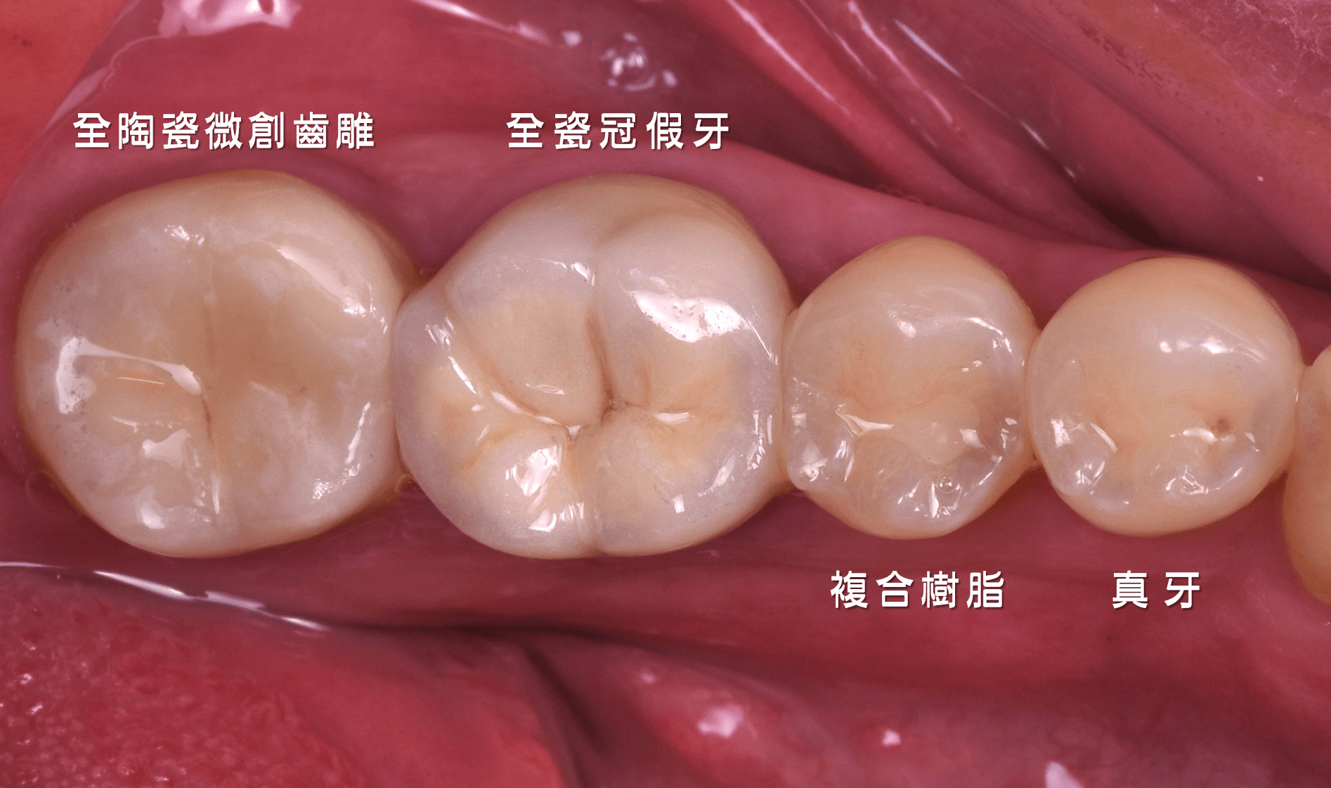 微創齒雕、全瓷冠假牙、複合樹脂、真牙