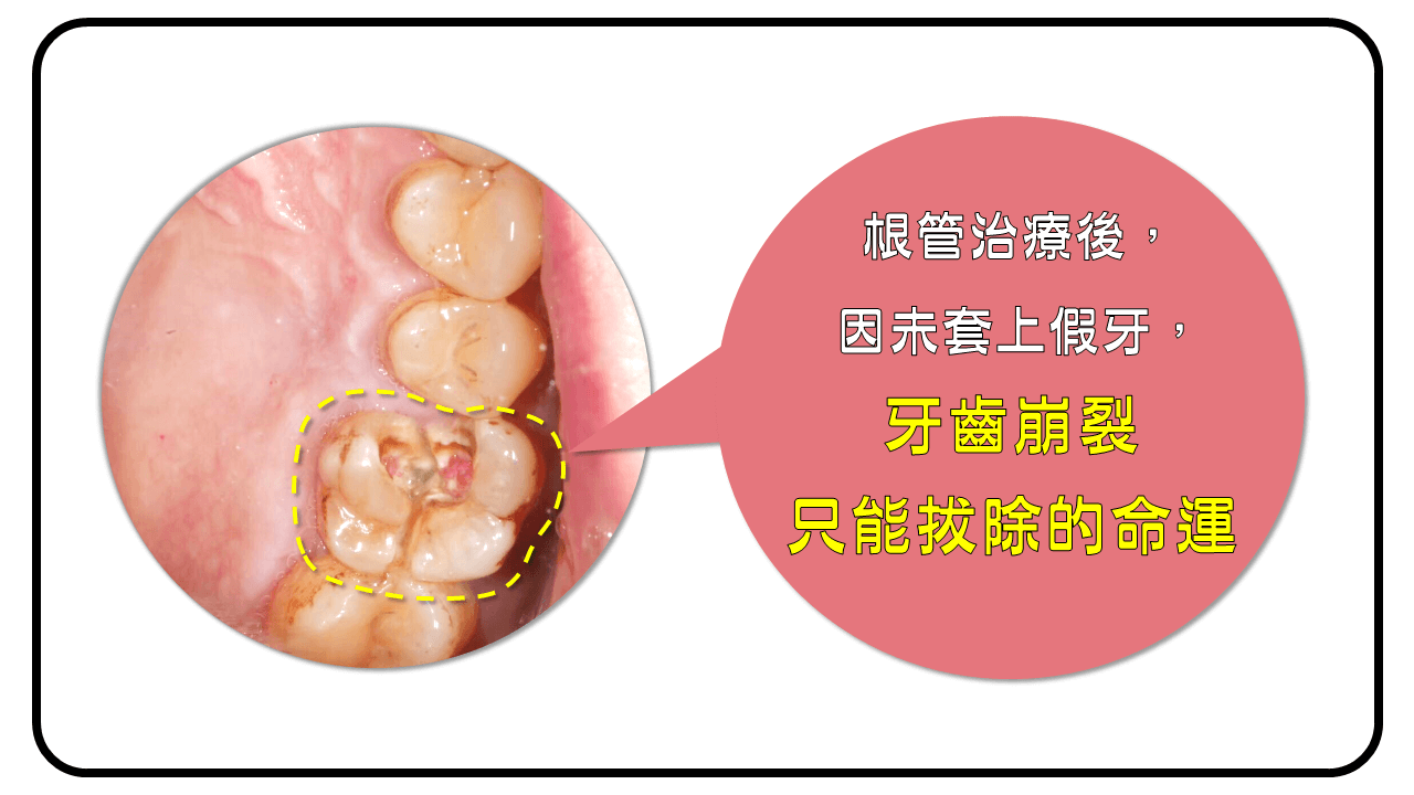 牙齒崩壞後只能拔除