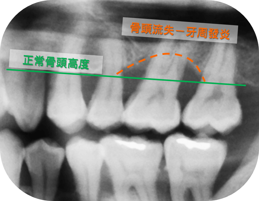 X光顯示骨頭高度