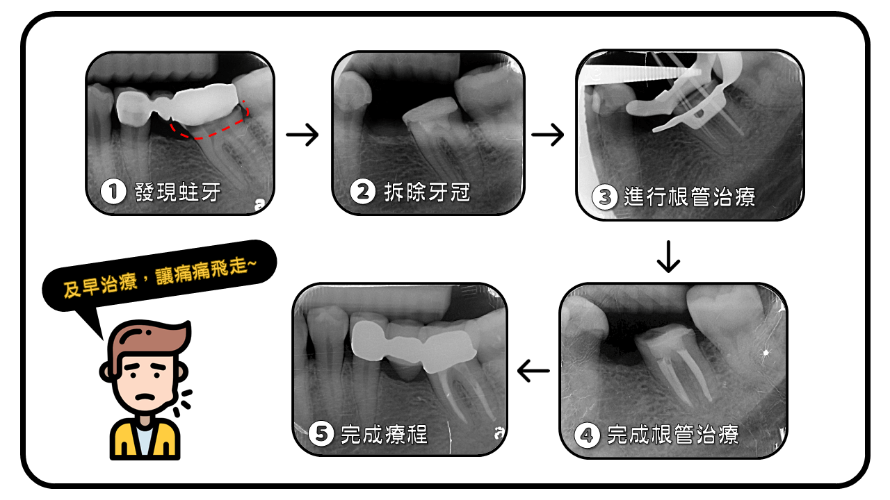 根管治療搭配X光流程