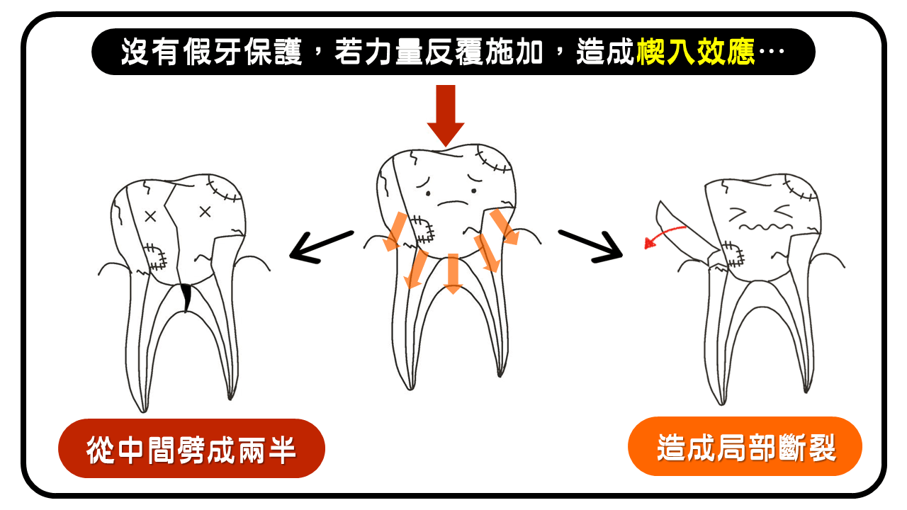 楔入效應可能造成牙齒斷裂