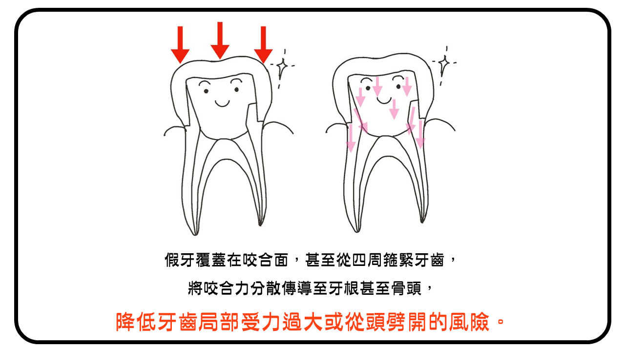套上假牙可分散咬合力