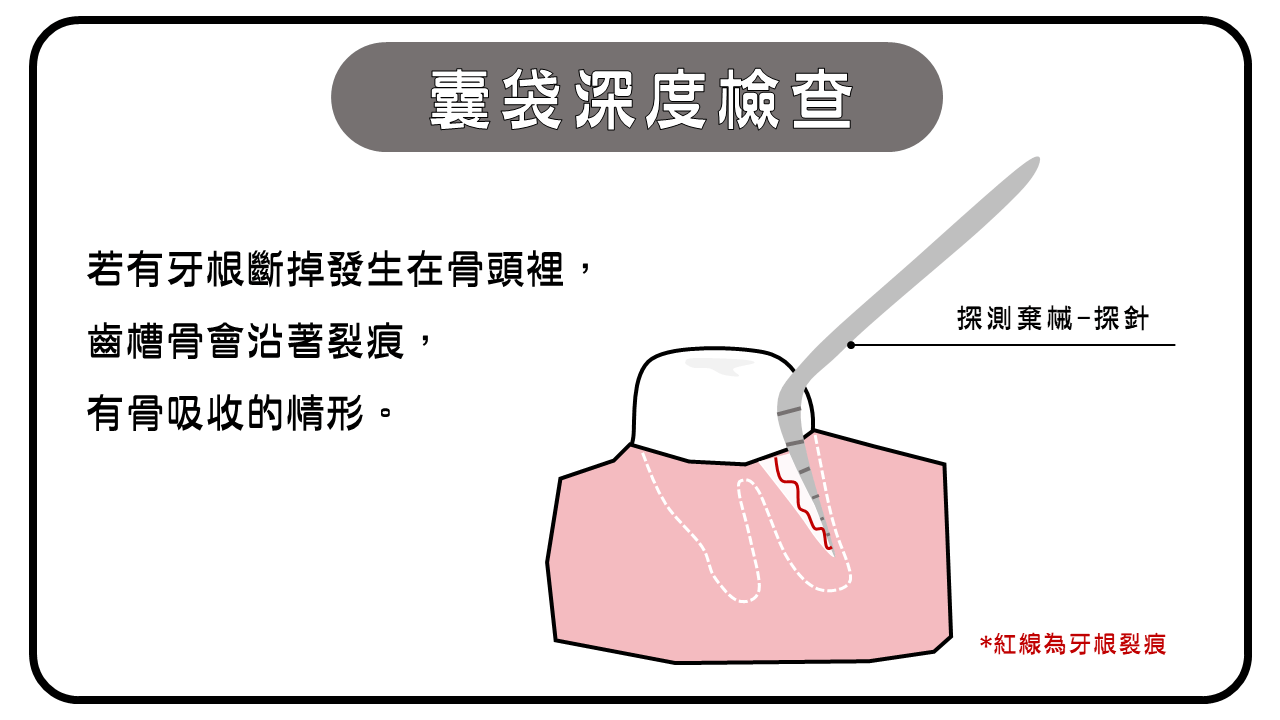 囊袋深度檢查