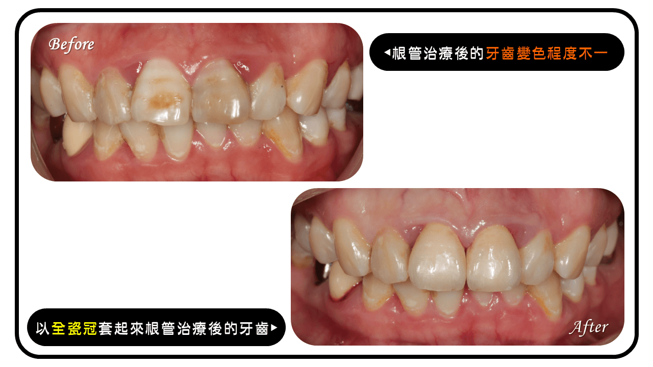 根管治療後牙齒變色,以全瓷冠改善美觀問題
