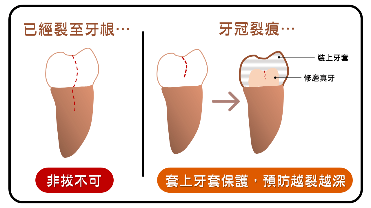 牙裂深度評估