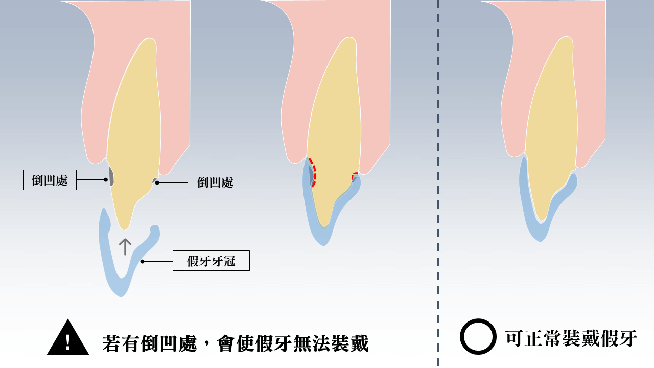 牙齒倒凹