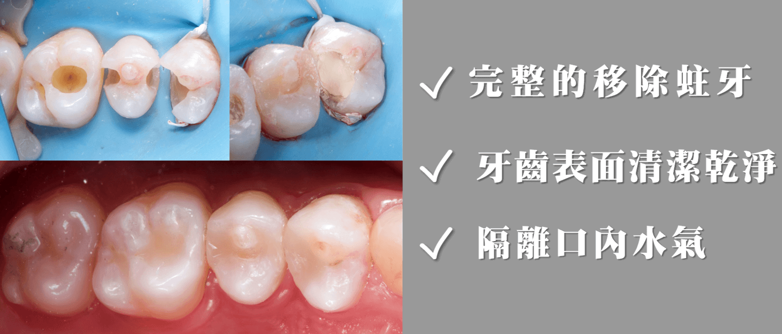 完整的移除蛀牙、牙齒表面清潔乾淨、隔離口內水氣