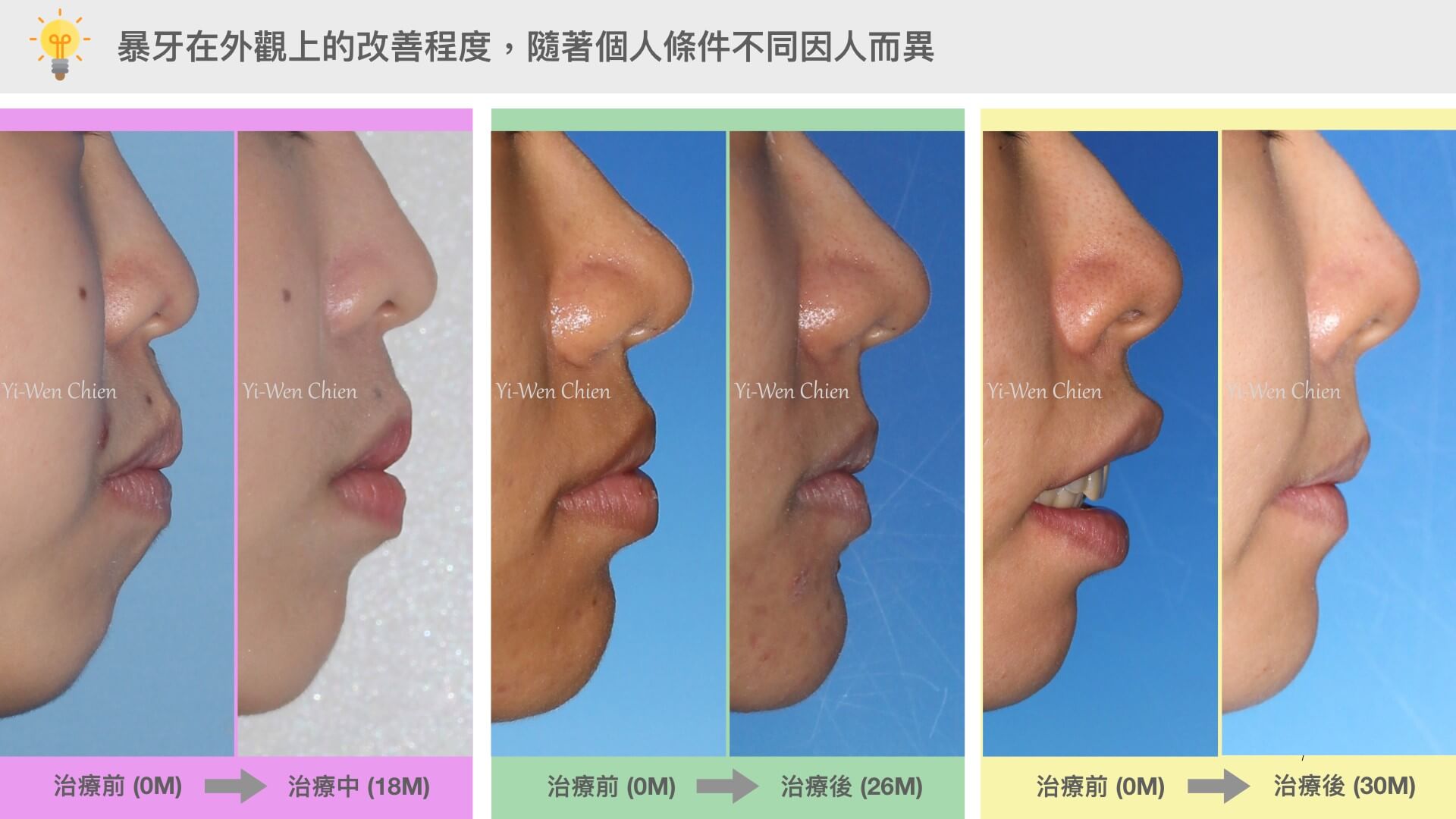牙齒矯正可以改變臉型嗎 會瘦臉嗎 牙齒大小事 竹北品悅牙醫 牙齒矯正可以改變臉型嗎 會瘦臉嗎 牙齒大小事 竹北品悅牙醫