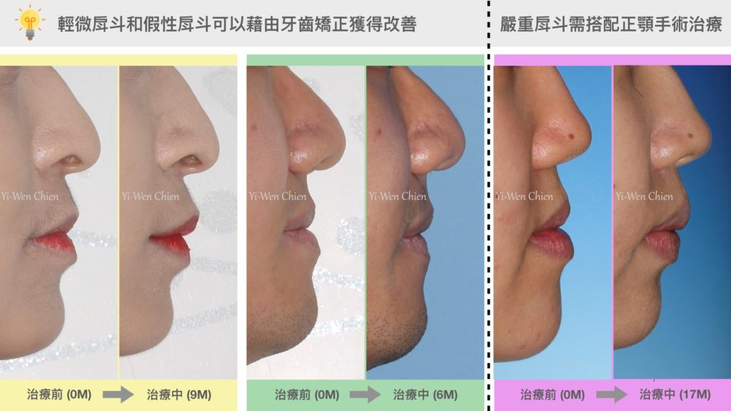 牙齒矯正