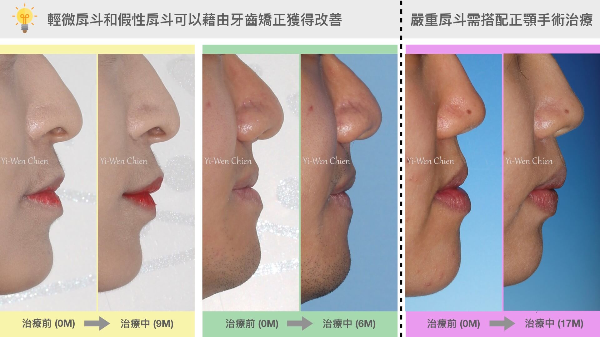 牙齒矯正可以改變臉型嗎 會瘦臉嗎 牙齒大小事 竹北品悅牙醫 牙齒矯正可以改變臉型嗎 會瘦臉嗎 牙齒大小事 竹北品悅牙醫