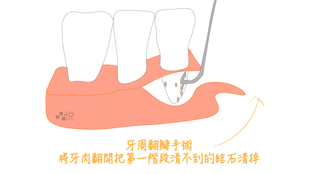 牙周翻瓣手術