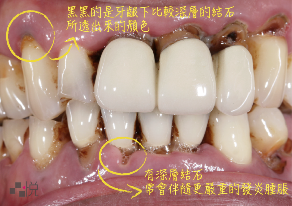 牙周病有深層 牙結石 常會伴隨更嚴重的發炎腫脹