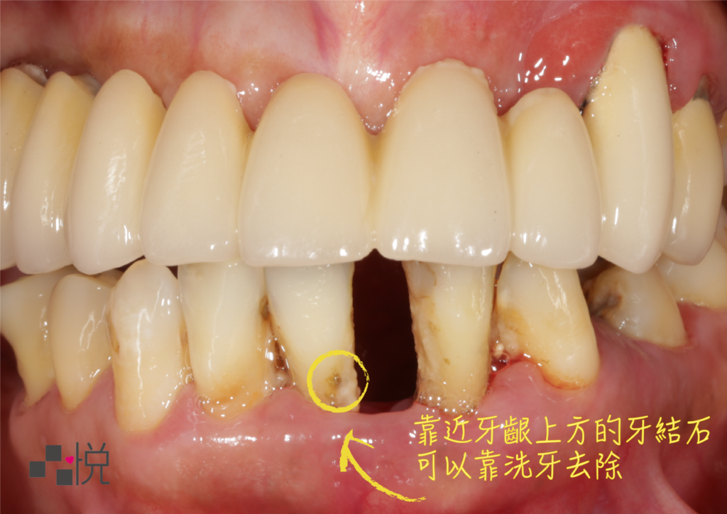 靠近牙齦上方的牙結石可以靠洗牙去除