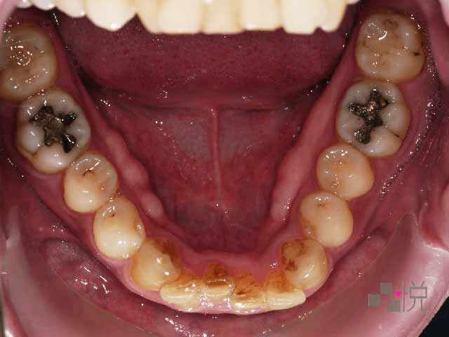 下顎矯正前的下排牙齒