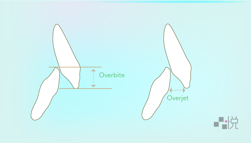 overbite overjet