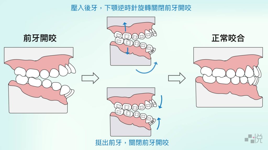 牙齒矯正壓入前後牙的方式