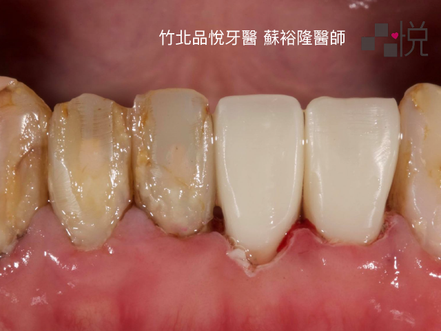 一個小黑點卻被磨出大洞 牙醫是不是想磨牙後做假牙發大財 品悅牙醫