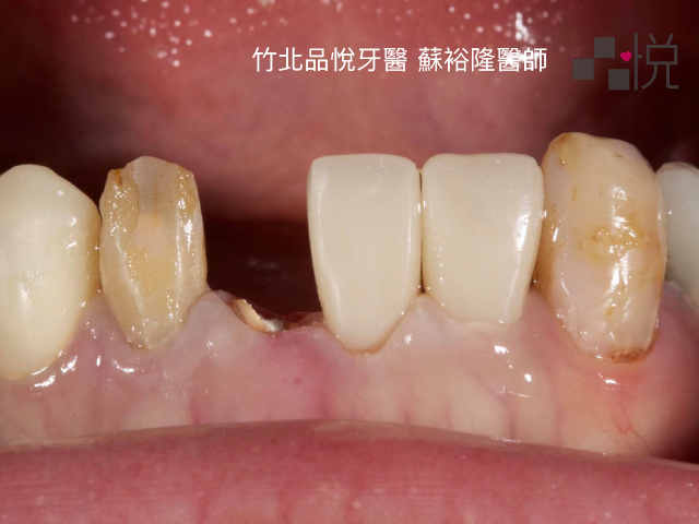有一顆牙齒裂掉剩斷根