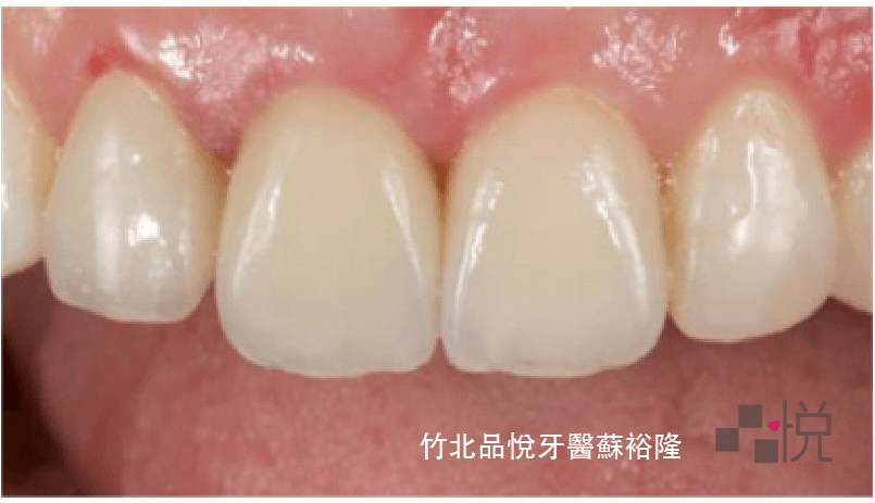 為什麼一定要戴臨時假牙 不能直接做正式假牙就好嗎 品悅牙醫blog