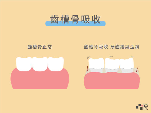 齒槽骨萎縮