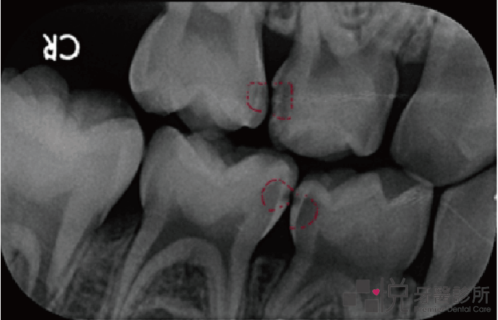 兒童乳牙牙縫蛀牙X光片