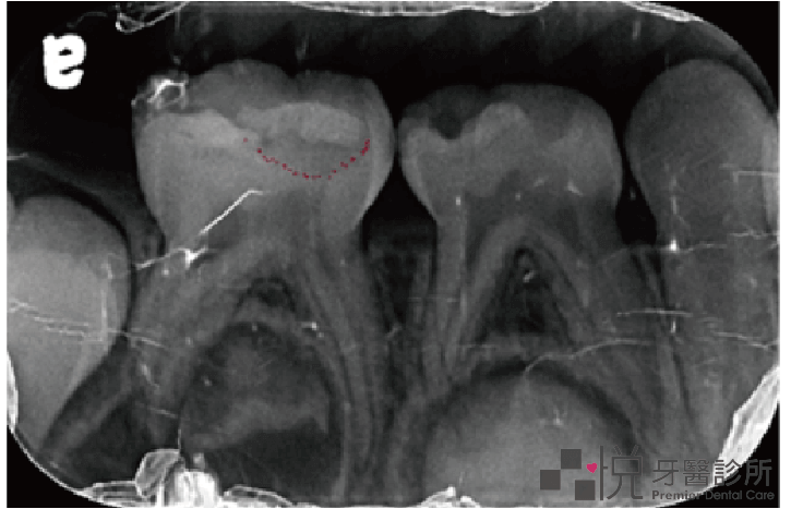 兒童牙齒填補物底下的二度蛀牙
