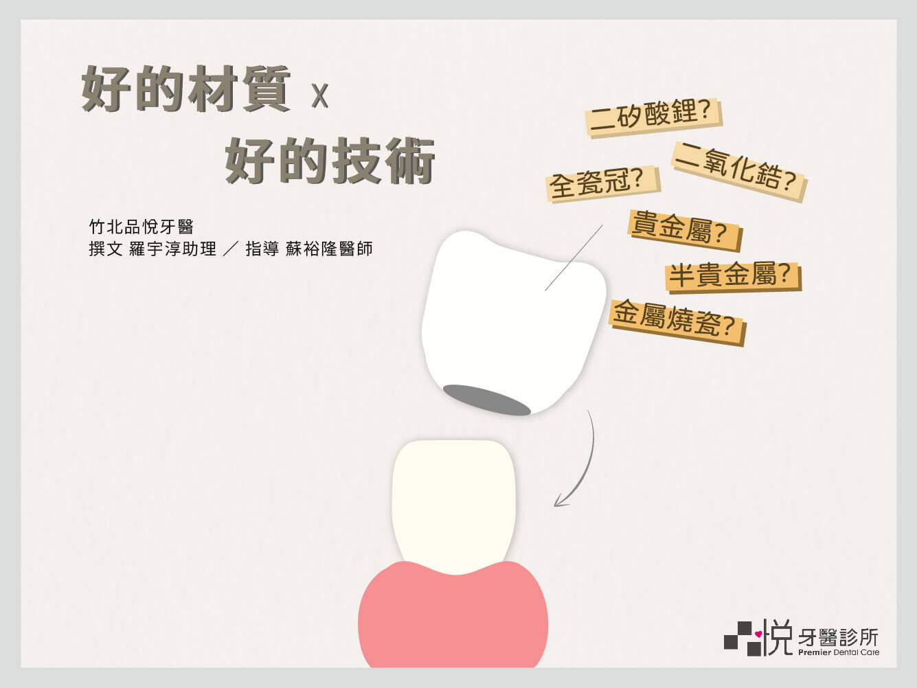 2021 根管治療完牙套種類 材質與廠牌比較 牙齒大小事 竹北品悅牙醫