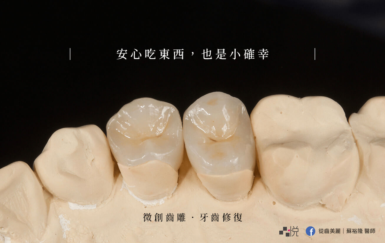 2021 根管治療完牙套種類 材質與廠牌比較 牙齒大小事 竹北品悅牙醫