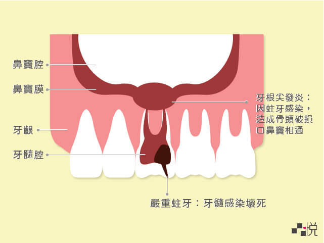 嚴重蛀牙感染鼻竇腔剖面圖