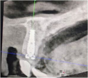 前牙植牙CT電腦斷層照片第一張