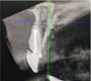 前牙植牙CT照片第二張