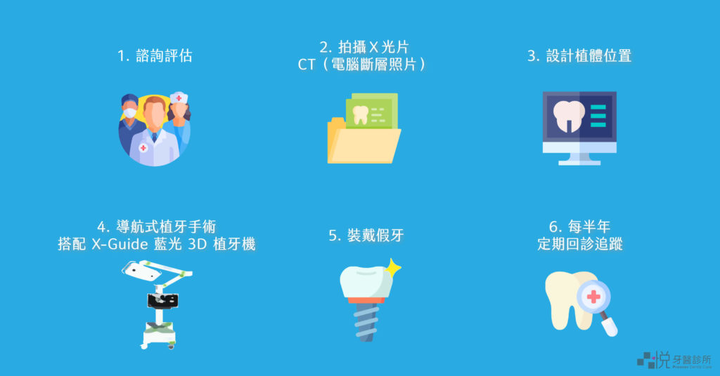 X-Guide藍光導航植牙流程圖
