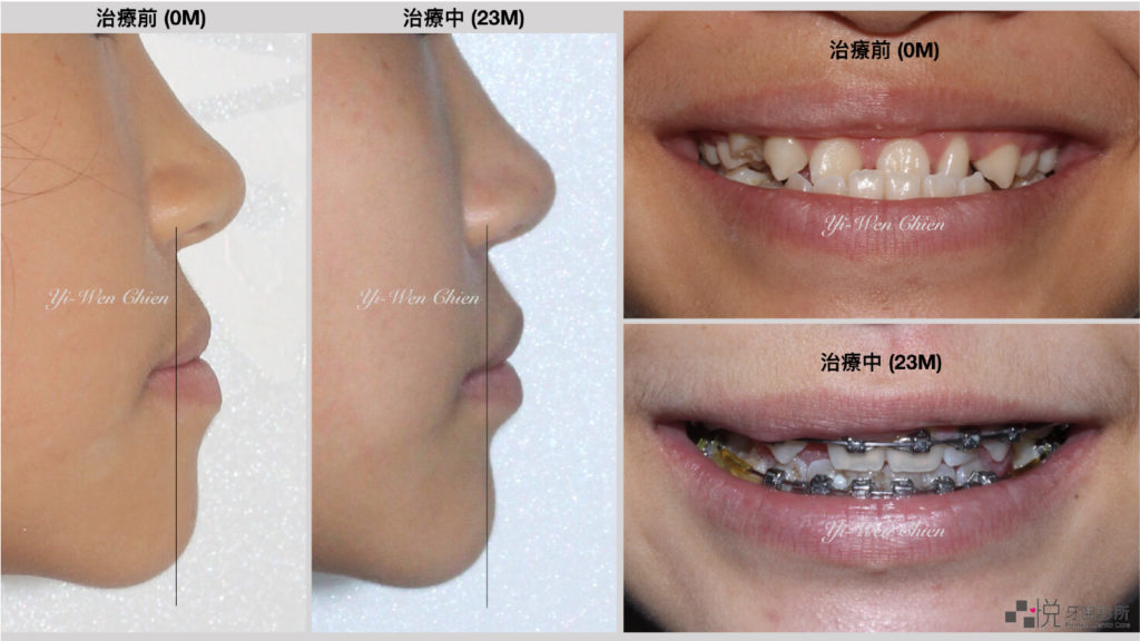 牙齒矯正戽斗和補缺牙案例