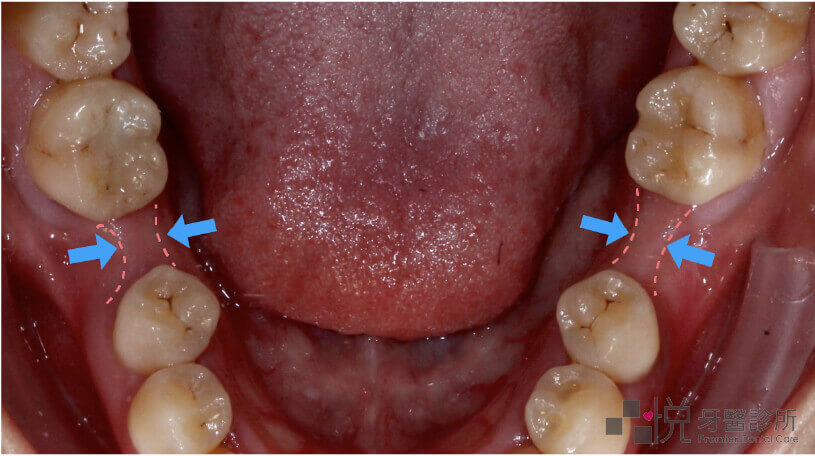 單顎齒槽骨萎縮案例照片