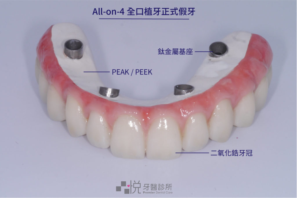 All-on-4 正式假牙