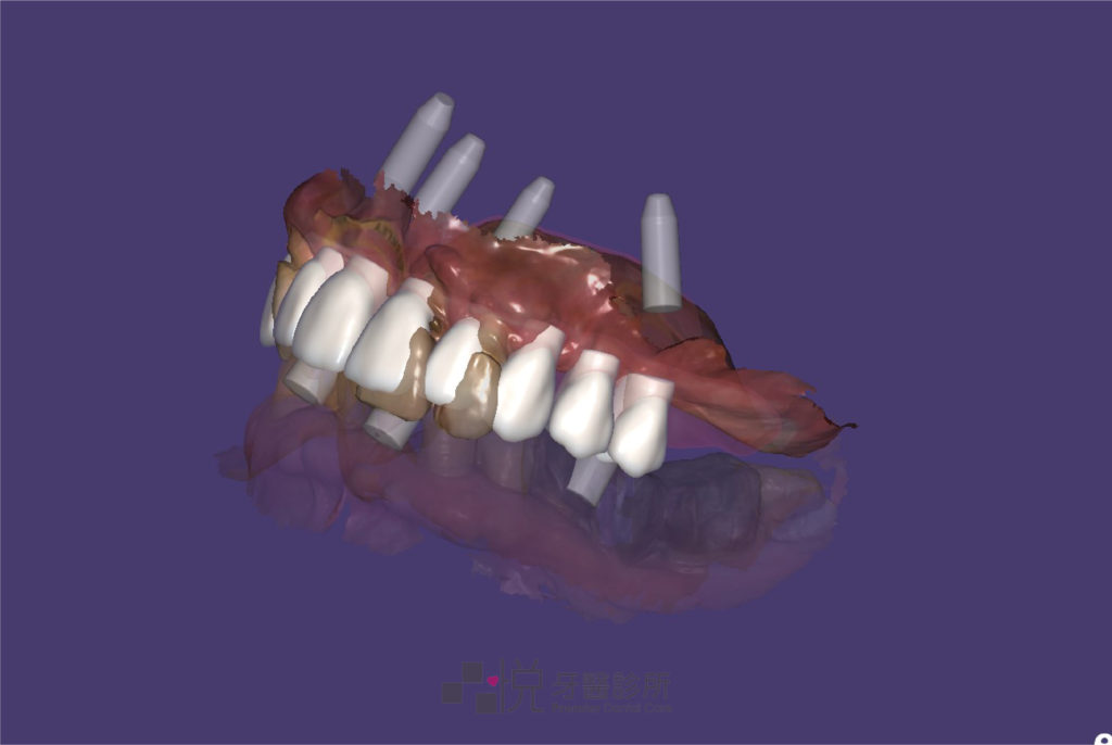 all-on-4 臨時假牙數位設計版