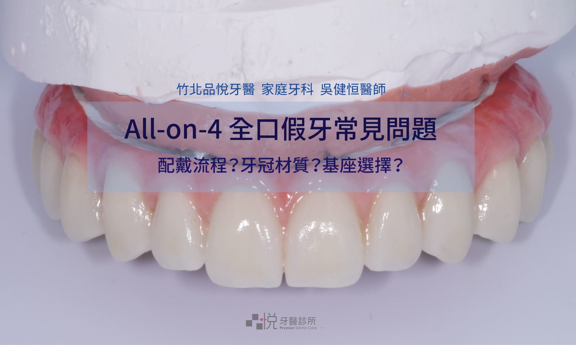 all-on-4全口植牙於石膏上的正式假牙照片