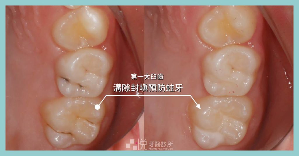 兒童換牙後施作窩溝封填