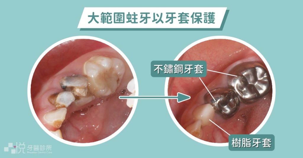 兒童乳牙換牙期間用小鋼牙保護