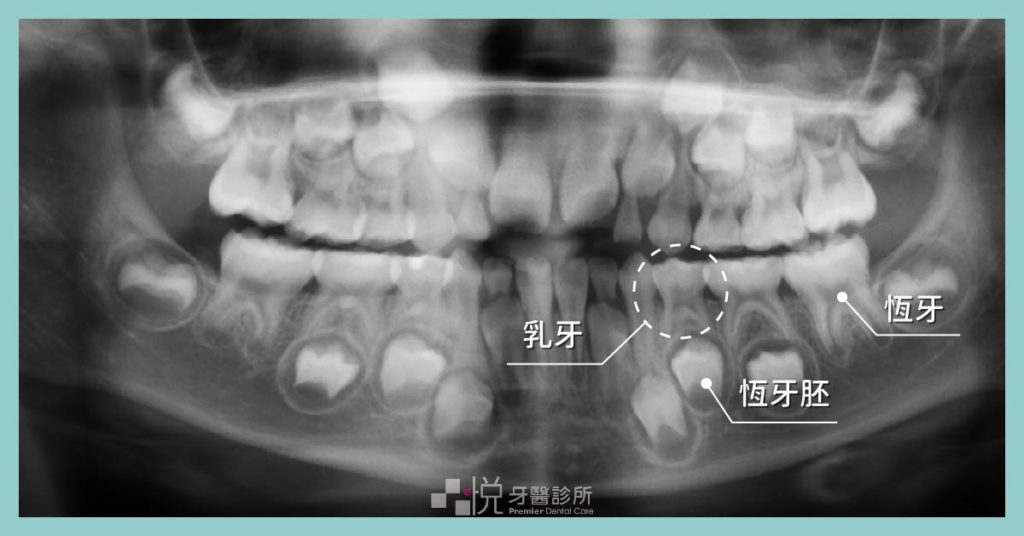 兒童乳牙與恆牙的全口Ｘ光片