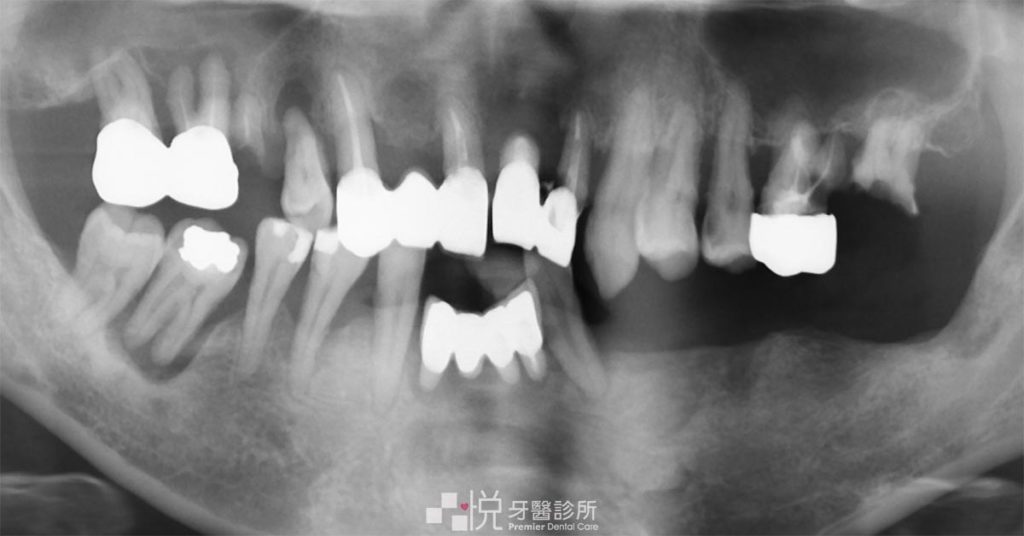 假牙的全口X光片