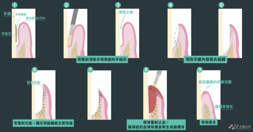 竹北水雷射牙周治療9步驟示意圖