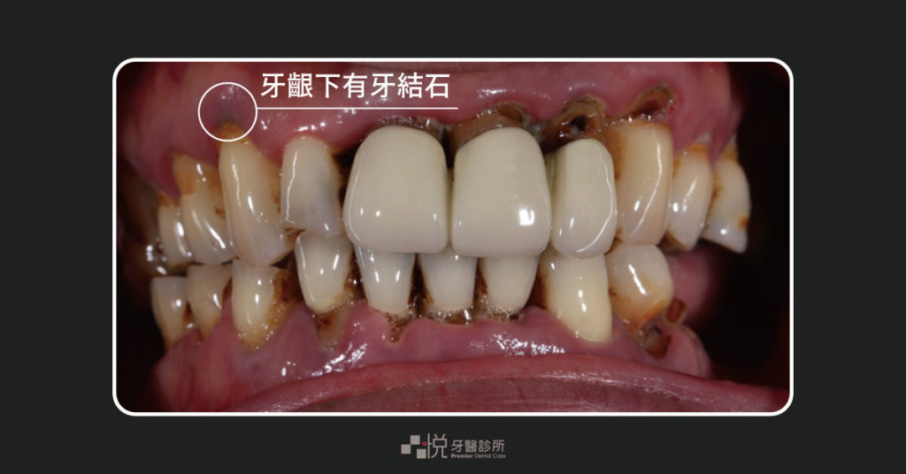 傳統牙周雷射術前有很多牙齦下牙結石