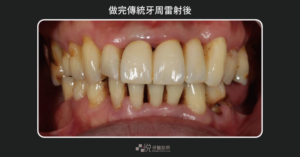 傳統雷射牙周術後牙齦消炎