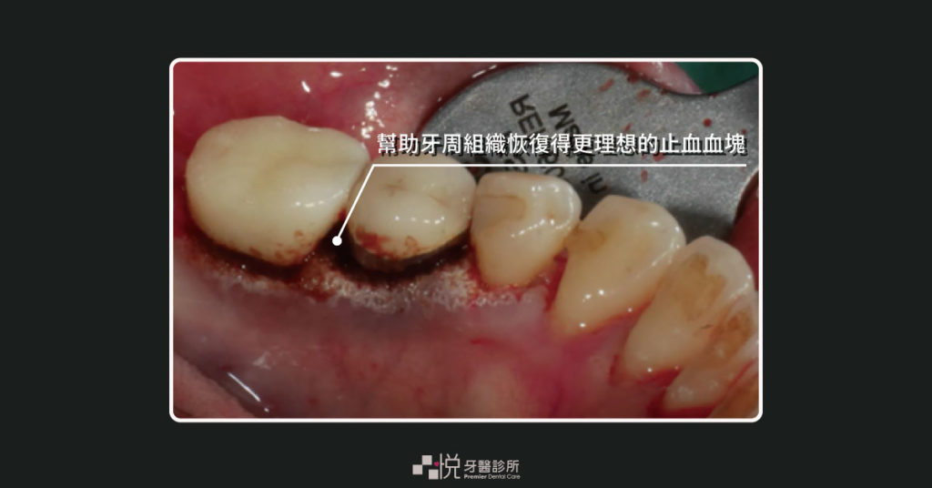 水雷射的止血血塊在牙齦與牙齒的接縫處